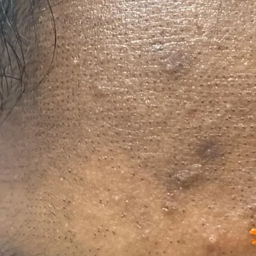 skin rashes treatment in trich