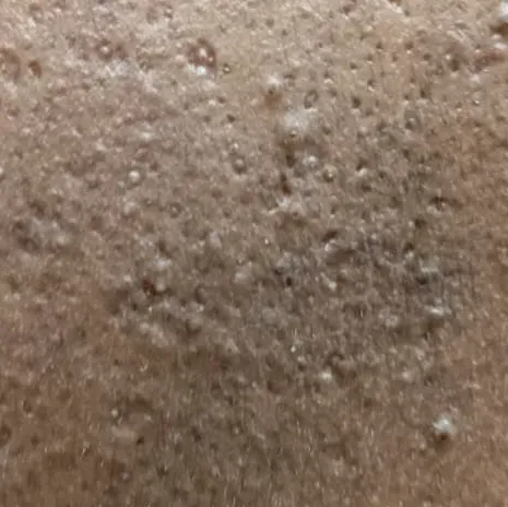 Dr.s.Valarmathi, an acne treat