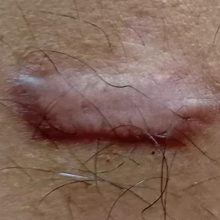 Dr.s.Valarmathi, a skin doctor