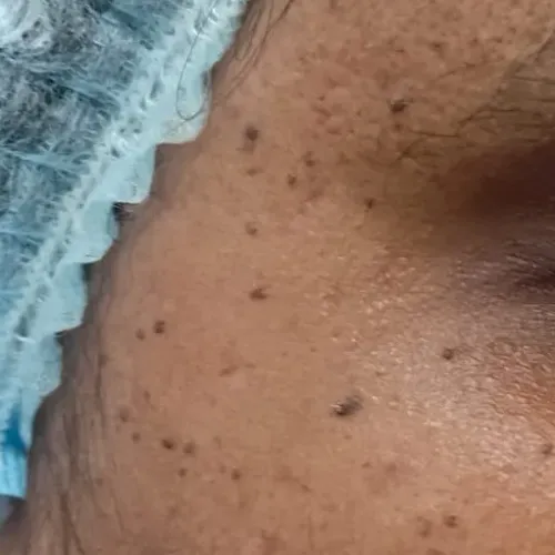 Dr.s.Valarmathi, a dermatologi