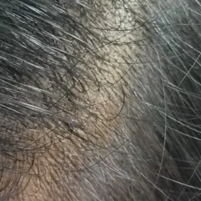 Dr.S.Valarmathi, a dermatologi