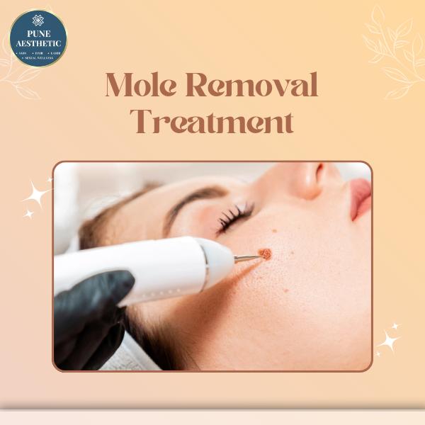 mole removal