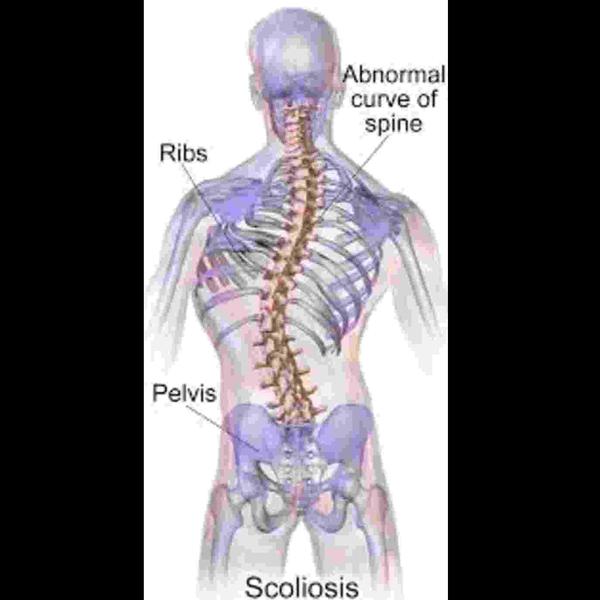 as management physiotherapy nf